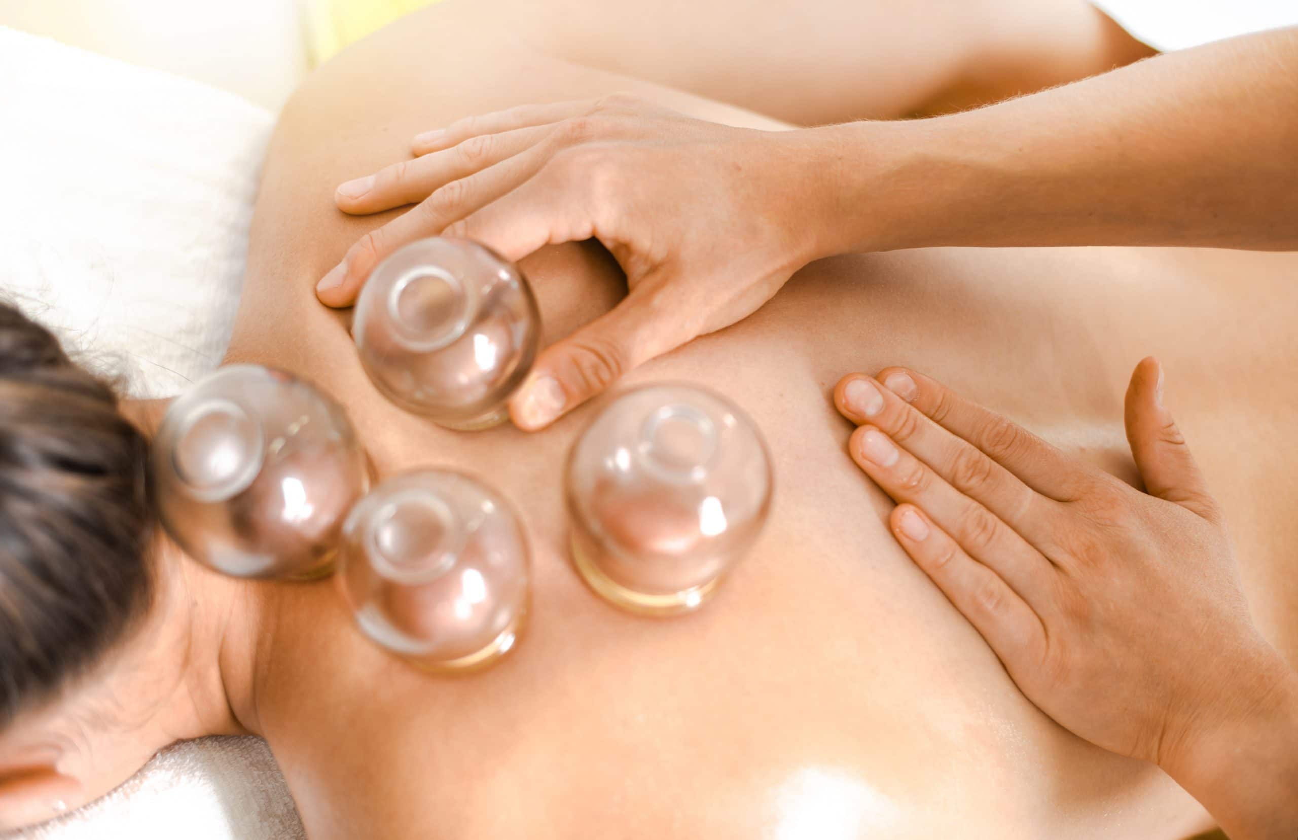 Cupping therapy by Metro Integrated Health in Victoria BC
